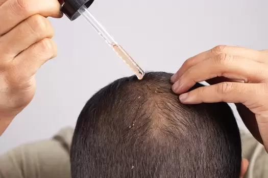 tratamento para queda de cabelo - minoxidil