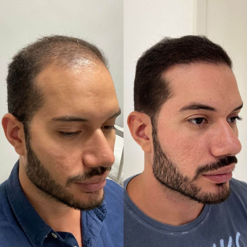 Antes e depois do procedimento realizado por Dr. Pablo Maciel (1)